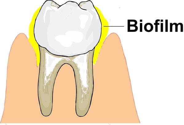 Everything You Need To Know About dental Biofilms