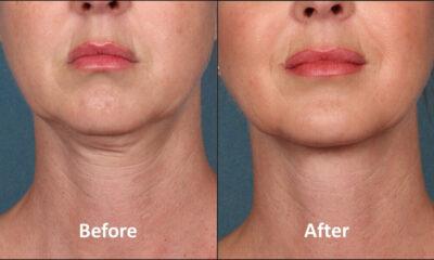 Aging Neck Treatment