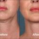 Aging Neck Treatment