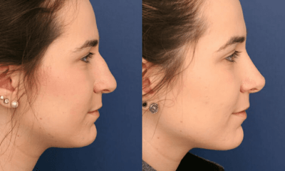 Rhinoplasty