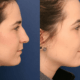 Rhinoplasty