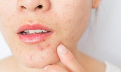 What You Should Know Before Popping That Pimple