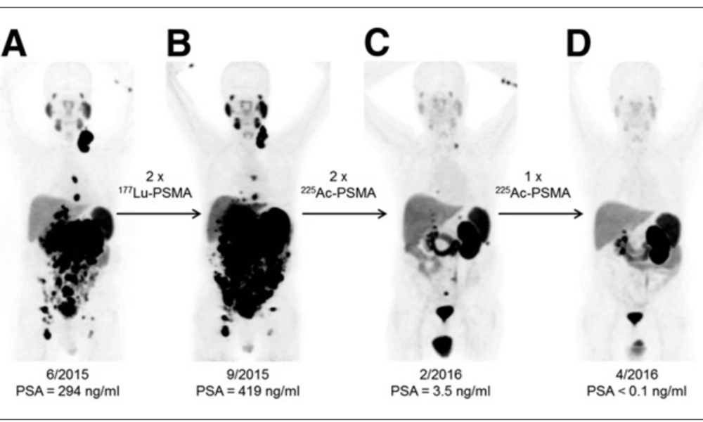 Cancer Treatment With Lutetium-177 PSMA - Lemony Blog