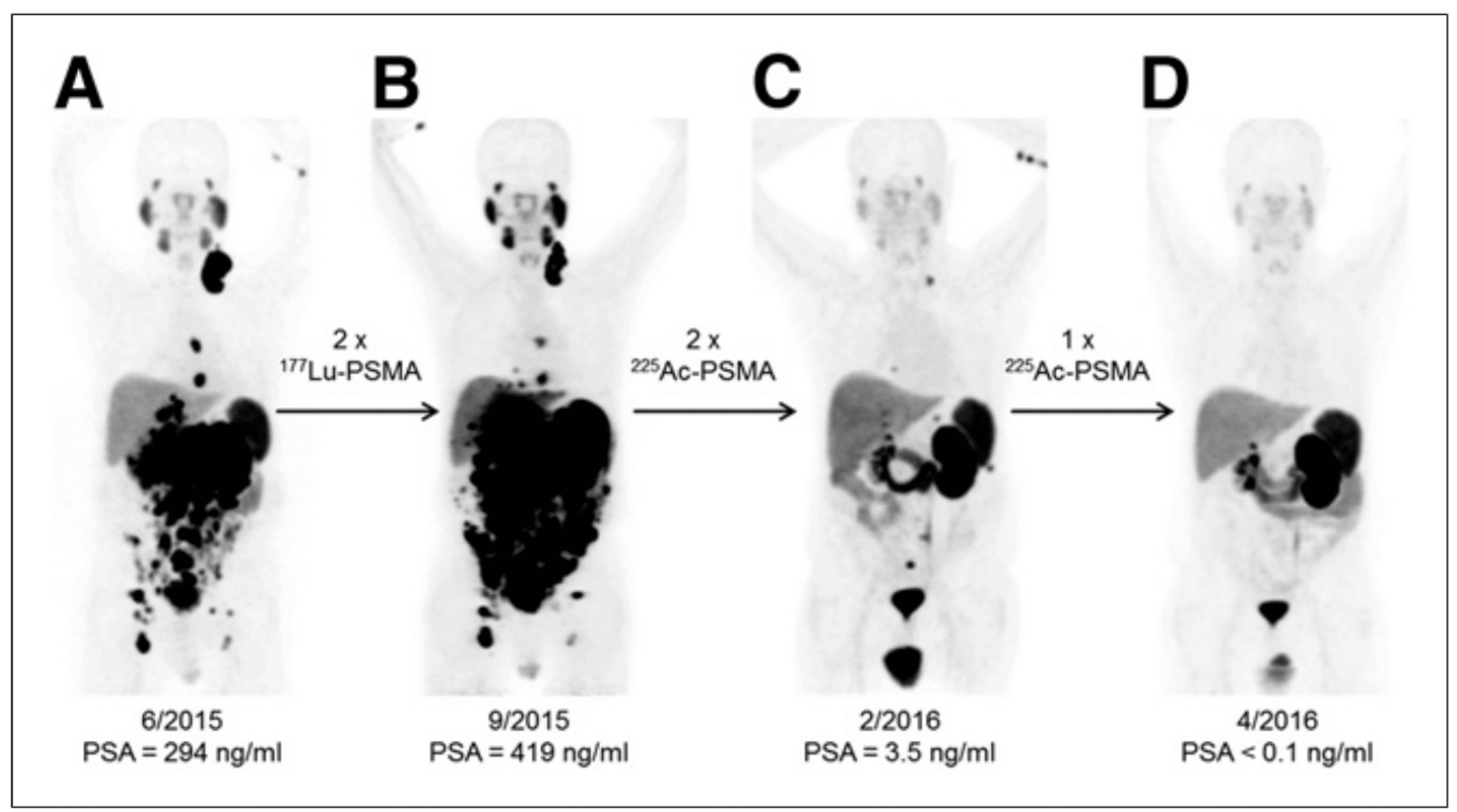 cancer-treatment-with-lutetium-177-psma-lemony-blog