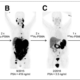 Cancer Treatment With Lutetium-177 PSMA