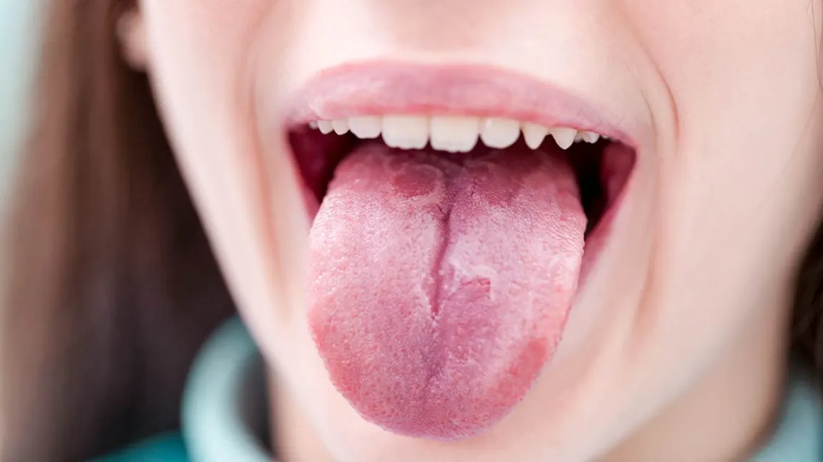 Everything You Need To Know About Geographic Tongue