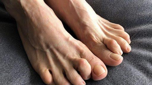 Soothe Hammertoes At Home